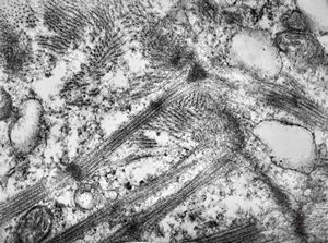 M,47y. | hypertrophic cardiomyopathy - left ventricle-crossing of myofilaments can also be caused arteficially with bioptom